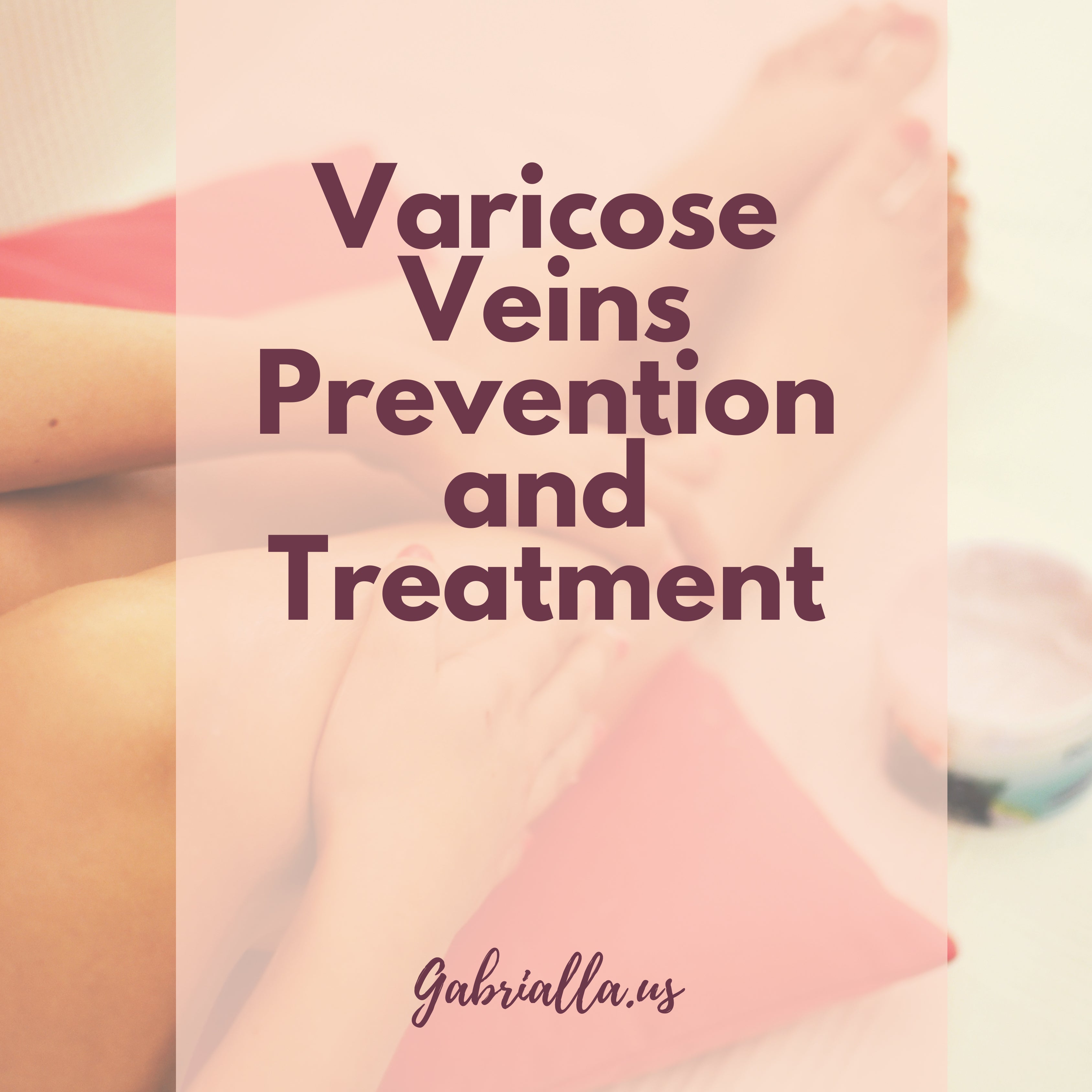 What are varicose veins? Prevention